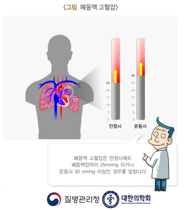 폐동맥 고혈압 그림-폐동맥 고혈압은 안정시에도 폐동맥압력이 25mmHg 이거나 운동시 30mmHg 이상인 경우를 말합니다