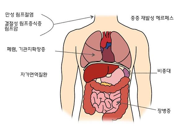 활성화된 PI3K 델타 증후군 증상 그림. 만성림프절염, 결절성 림프증식증, 림프암, 중증 재발성 헤르페스, 폐렴, 기관지확장증, 자가면역질환, 비종대, 장병증