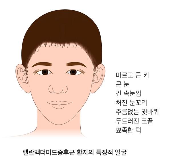 펠란맥더미드증후군 환자의 특징적 얼굴 그림-마르고 큰 키,큰 눈,긴 속눈썹,처진 눈꼬리,주름없는 귓바퀴,두드러진 코끝,뾰족한 턱