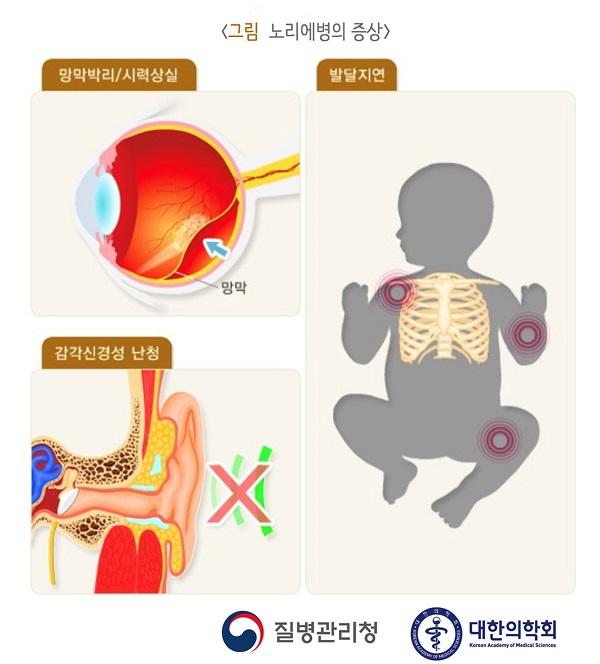 노리에병의 증상 그림-망막박리/시력상실,감각신경성 난청,발달지연