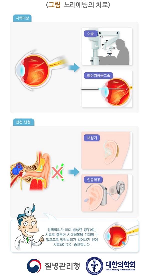 노리에병의 치료 그림-시력이상:수술,레이저광응고술,선천 난청:보청기,인공와우,망막발리가 이미 발생한 경우에는 치료로 충분한 시력회복을 기대할 수 없으므로 망막박리가 일어나기 전에 치료하는 것이 중요합니다.