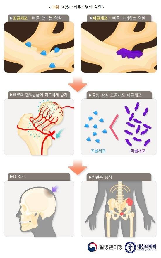 고함-스타우트 병의 원인: 뼈로의 혈액공급이 과도하게 증가하여 조골세포(뼈를 만드는 역할)보다 파골세포(뼈를 파괴하는 역할)의 수가 증가하여 균형이 상실되는 과정을 통해 뼈 상실, 혈관종 증식이 발생