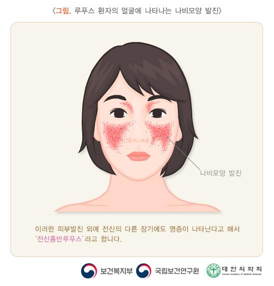 루푸스 환자의 얼굴에 나타나는 나비모양 발진