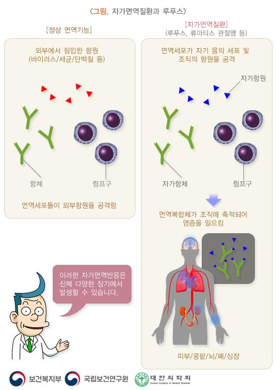 자가면역질환과 루푸스