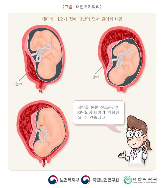 <그림. 태반조기박리> 태아가 나오기 전에 태반이 먼저 떨어져 나옴. 태반을 통한 산소공급이 차단되어 태아가 위험해 질 수 있습니다.