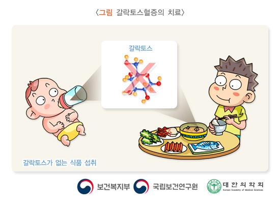 갈락토스 혈증의 치료