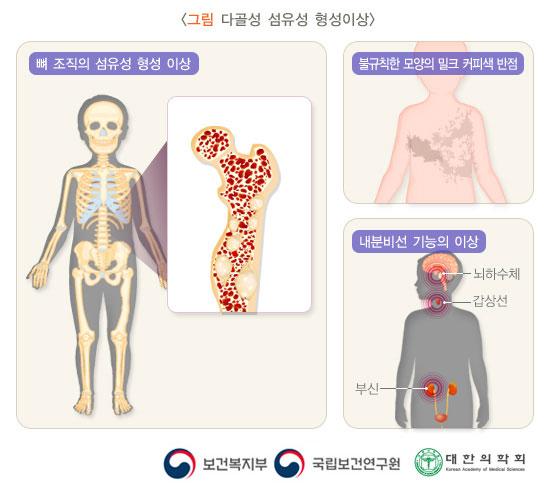 다골성 섬유성 형성이상