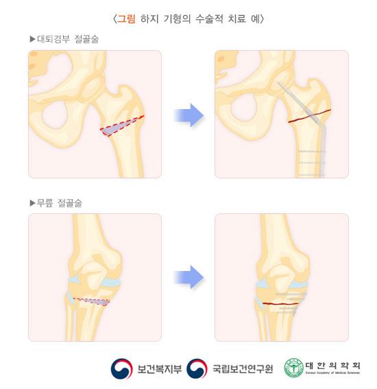 하지 기형의 수술적 치료 예