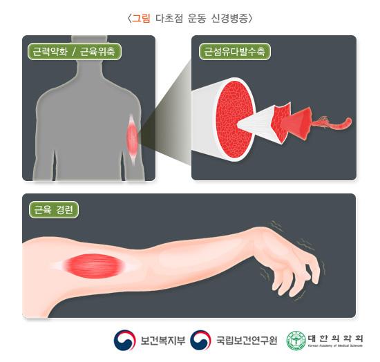 다초점 운동 신경병증