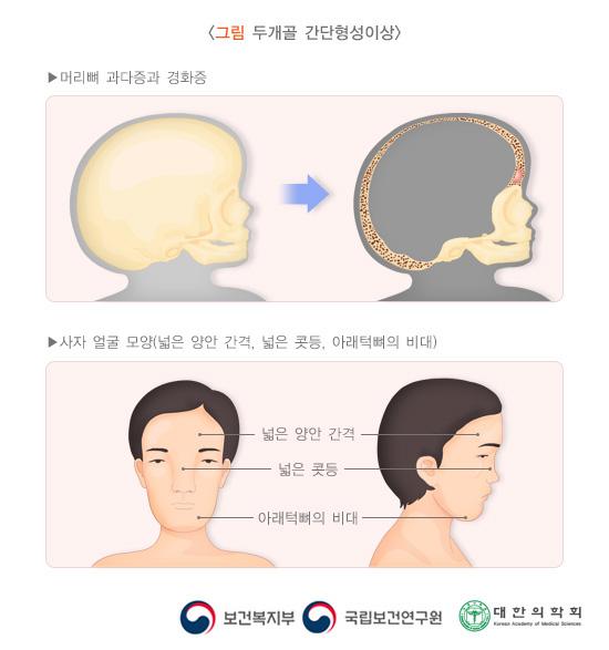 두개골 간단형성이상의 특징: 머리뼈 과다증과 경화증, 사자 얼굴 모양(넓은 양안 간격, 넓은 콧등, 아래턱뼈의 비대)