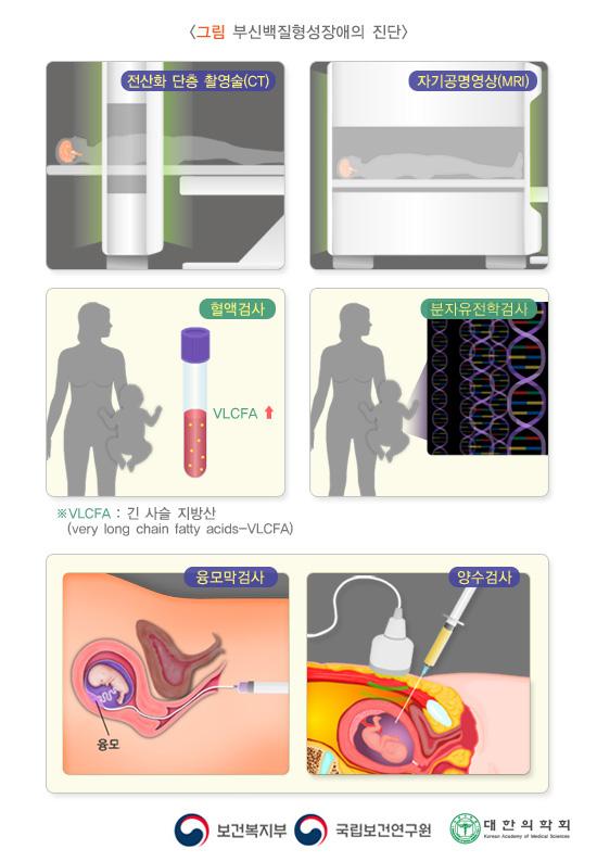 부신백질형성장애의 진단