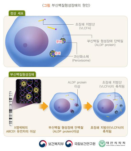 부신백질형성장애의 원인