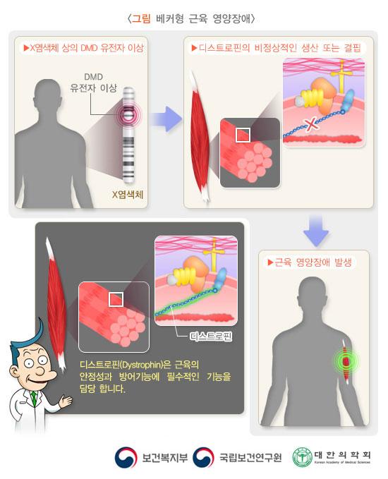 베커형 근육 영양장애