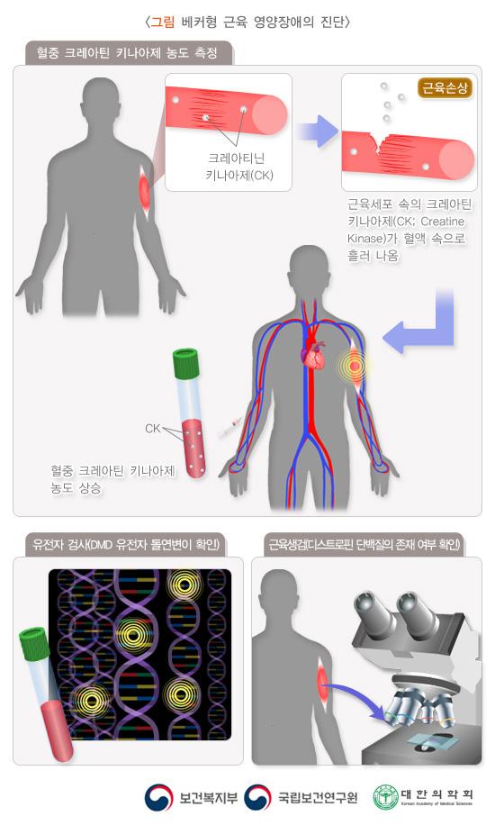 베커형 근육 영양장애의 진단