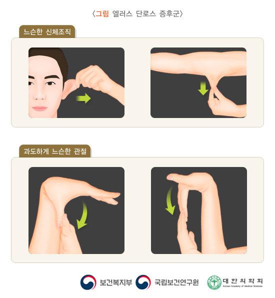 엘러스 단로스증후군