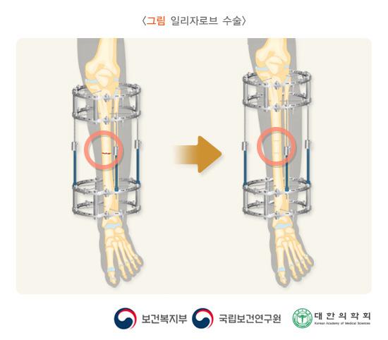 일리자로브 수술