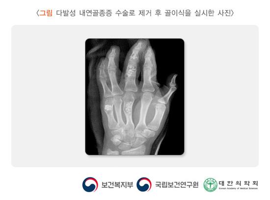 다발성 내연골종증 수술로 제거 후 골이식을 실시한 사진
