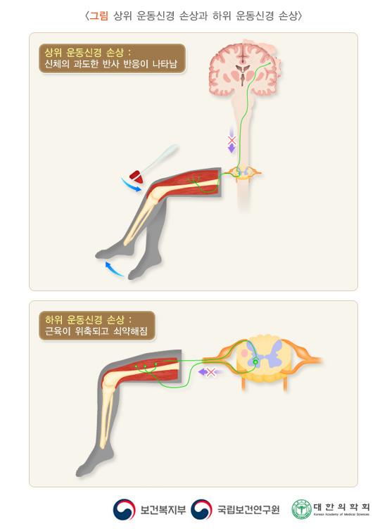 상위 운동신경 손상과 하위 운동신경 손상