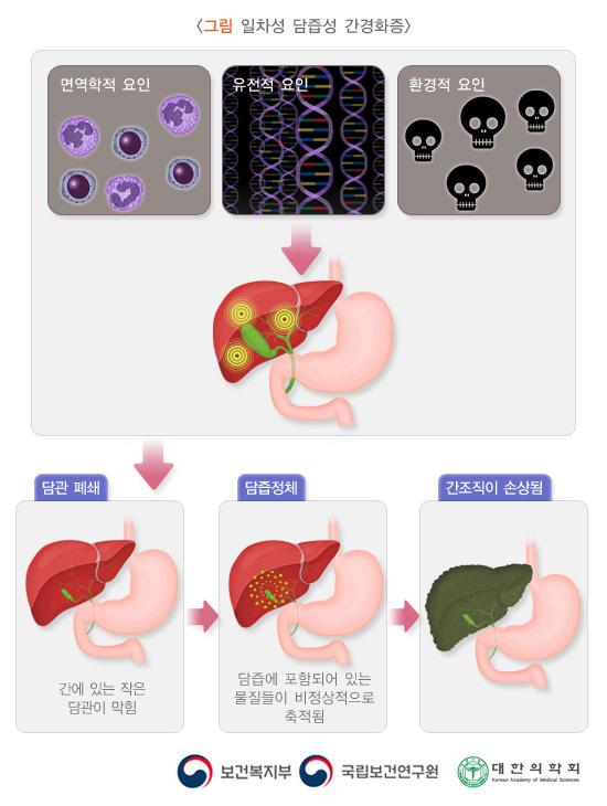 일차성 담즙성 간경화증 그림. 면역학적 요인, 유전적 요인, 환경적 요인 > 담관폐쇄(간에 있는 작은 담관이 막힘)> 담즙정체(담즙에 포함되어 있는 물질들이 비정상적으로 축적됨)> 간조직이 손상됨. 보건복지부, 국립보건연구원, 대한의학회