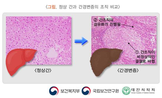 정상 간과 간경변증의 조직 비교 그림. 정상간 > 간견변증. 1. 간조직이 비정상적인 결절로 바뀜. 2. 간조직의 섬유화가 진행됨. 보건복지부, 국립보건연구원, 대한의학회