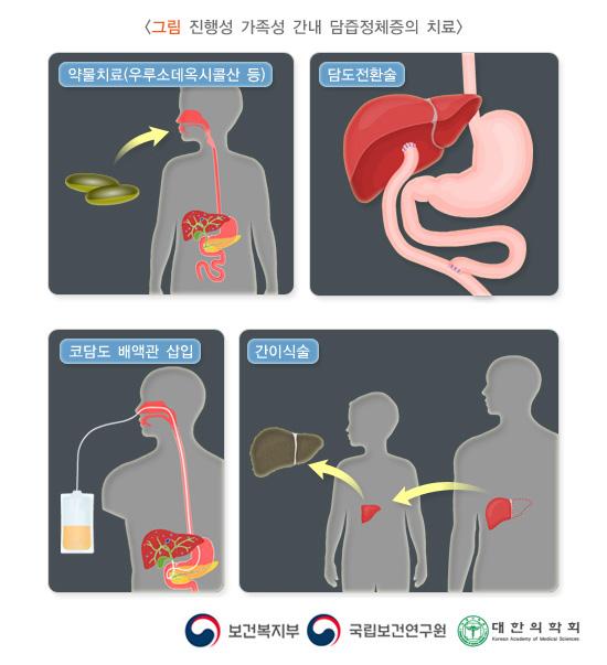 진행성 가족성 간내 담즙정체증의 치료 방법 그림: 약물치료(우루소데옥시콜산 등), 담도전환술, 코담도 배액관 삽입, 간이식술