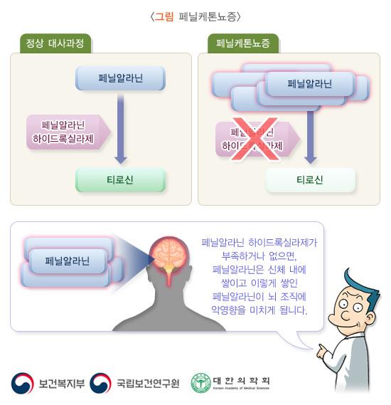 페닐케톤뇨증