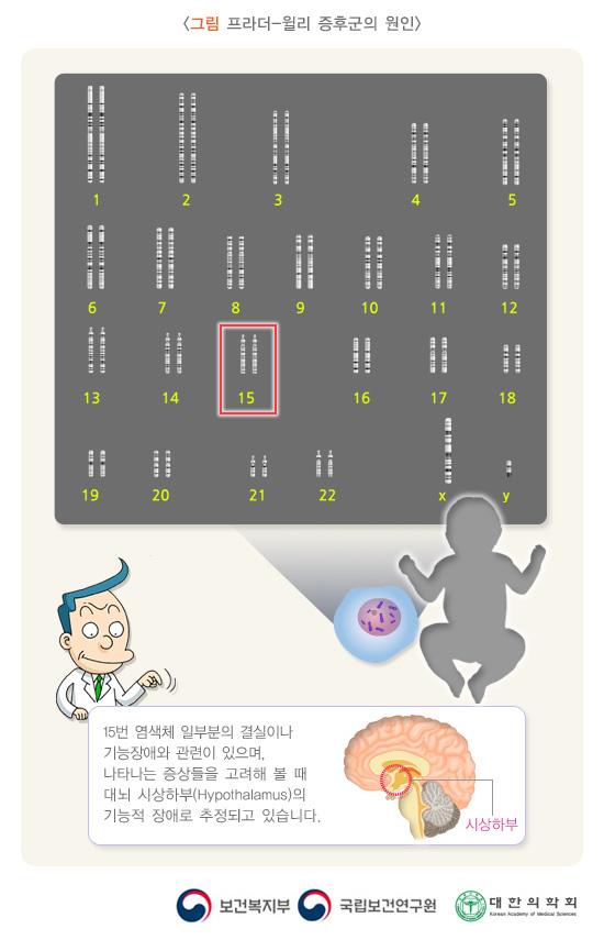 프라더-윌리 증후군의 원인