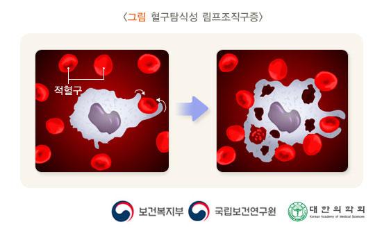 혈구탐식성 림프조직구증후군