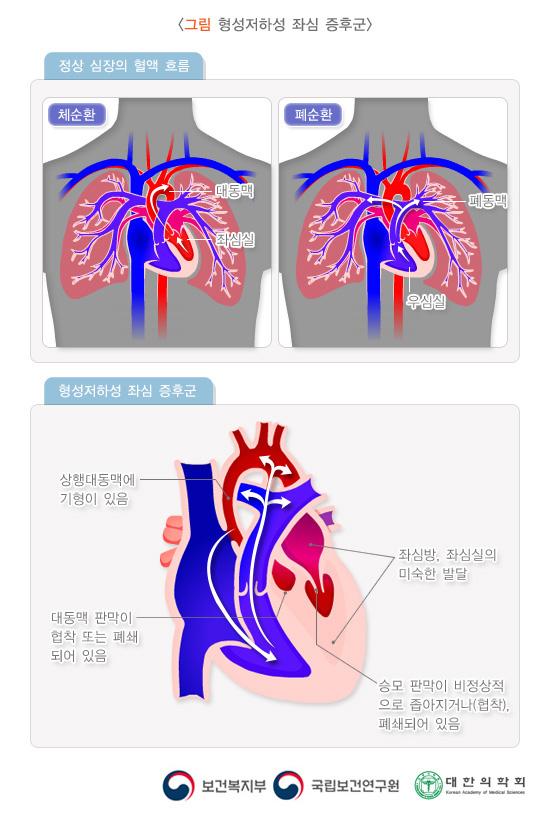 형성저하성 좌심 증후군