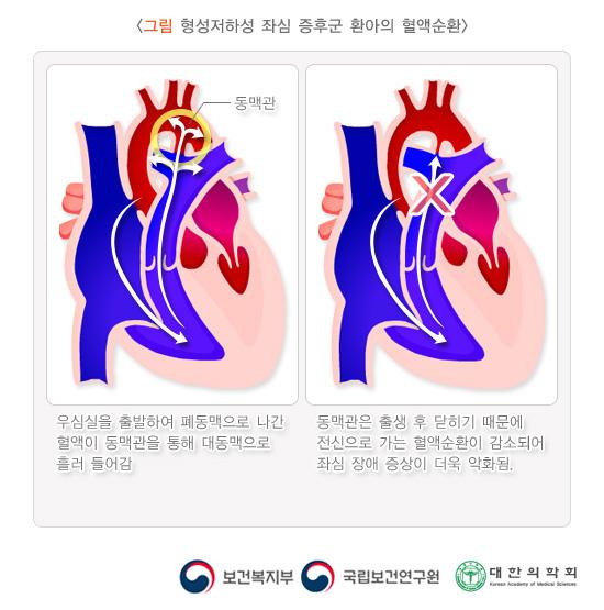형성저하성 좌심 증후군 환아의 혈액순환