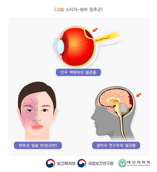 스터지-웨버 증후군