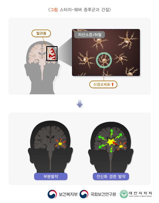 스터지-웨버 증후군과 간질