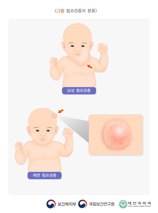 림프관종의 분류: 낭성 림프관종, 해면 림프관종