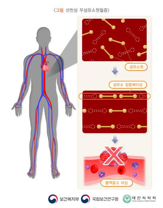 선천성 무섬유소원혈증