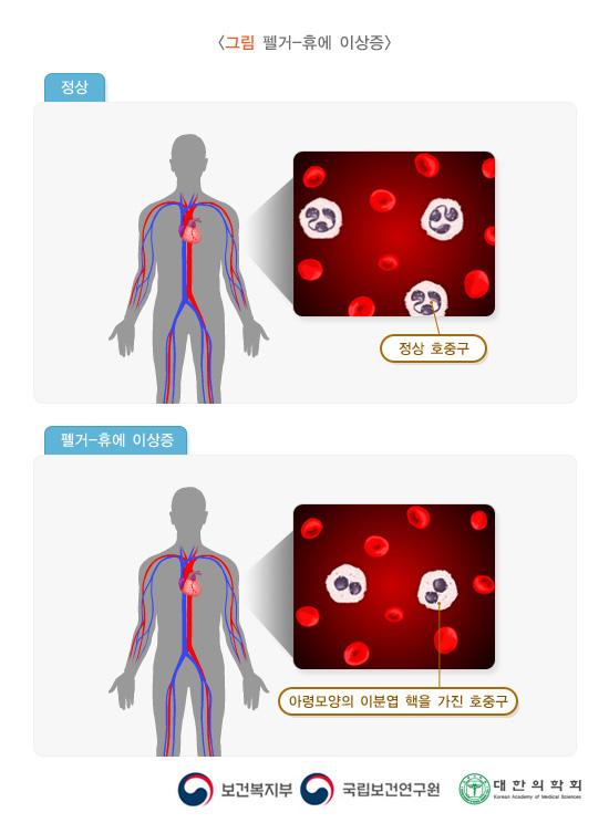 펠거-휴엣이상(과립,과립구)또는 증후군의 아령모양의 이분엽 핵을 가진 호중구와 정상 호중구의 비교 사진