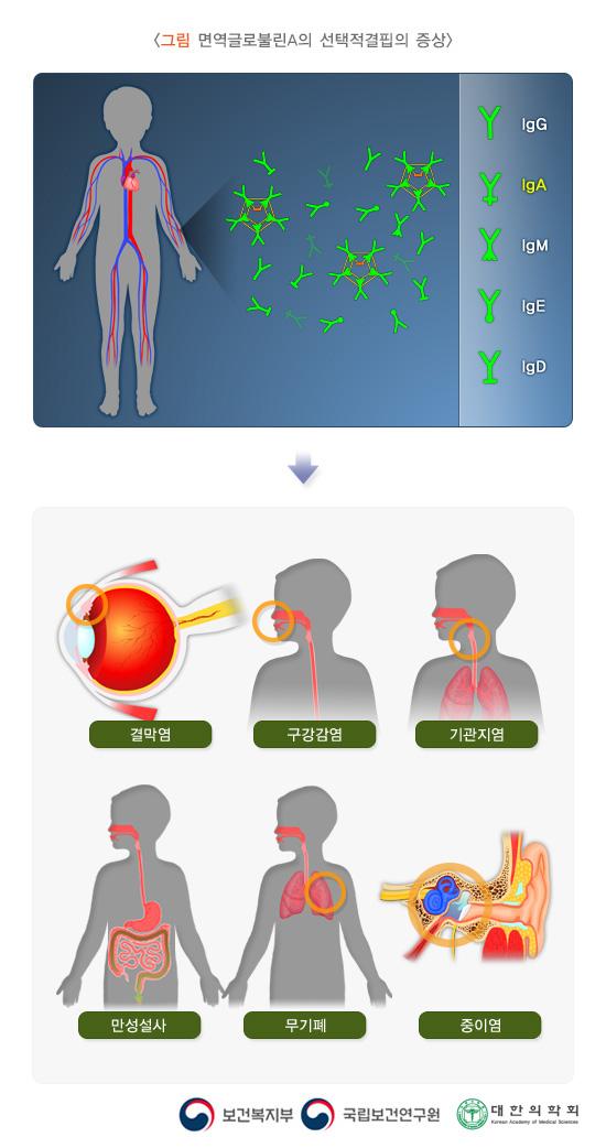 면역글로불린A의 선택적결핍의 증상
