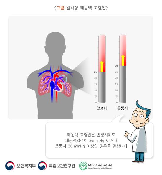 일차성 폐동맥 고혈압
