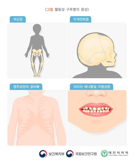활동성 구루병의 증상