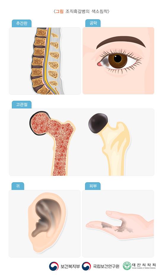 조직흑갈병의 색소침착