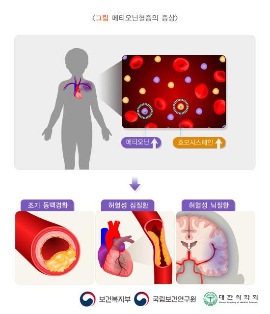 메티오닌혈증의 증상