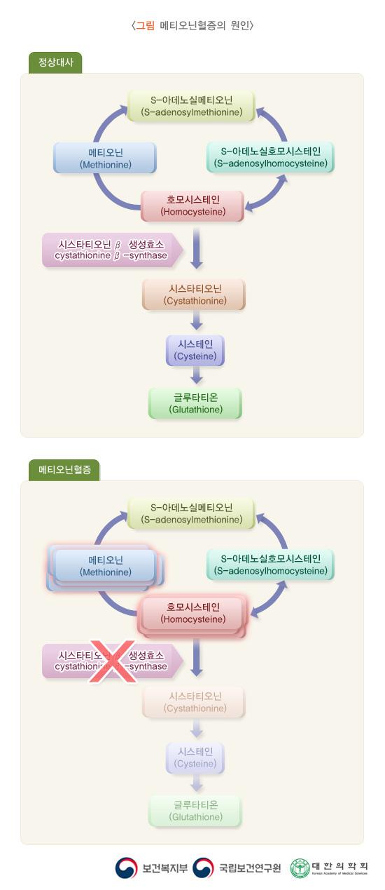 메티오닌혈증의 원인