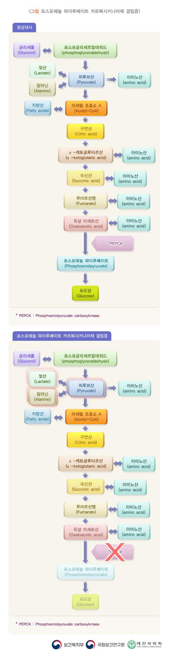 포스포에놀 파이루베이트 카르복시키나아제 결핍증