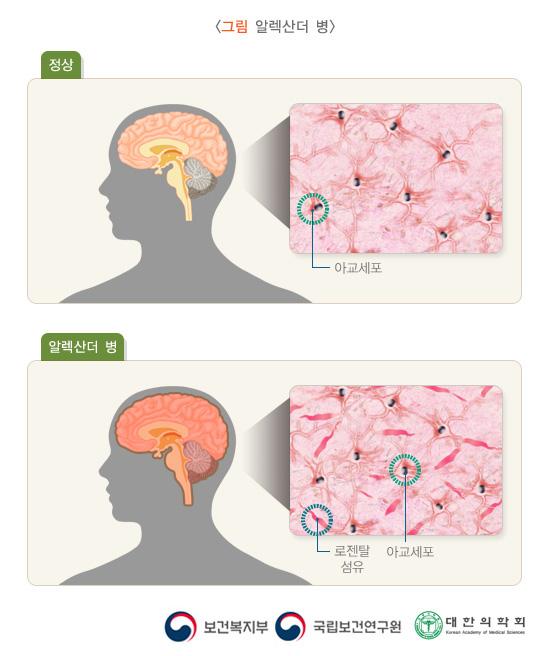 알렉산더병: 정상인의 아교세포와 알렉산더 병의 아교세포, 로젠탈 섬유 비교 사진