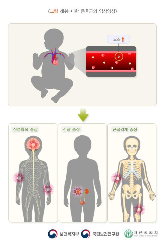 레쉬-니한증후군의 임상양상