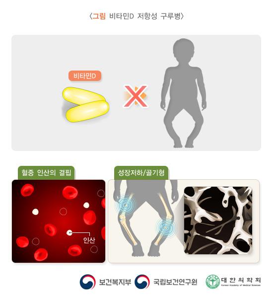 비타민D 저항성 구루
