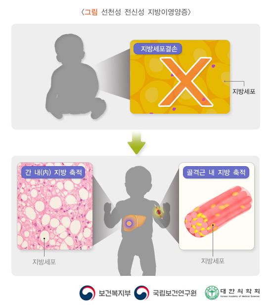 그림 선천성 전신성 지방이영양증. 지방세포결손. 간 내(內) 지방 축적. 골격근 내 지방 축적. 보건복지부, 국립보건연구원, 대한의학회