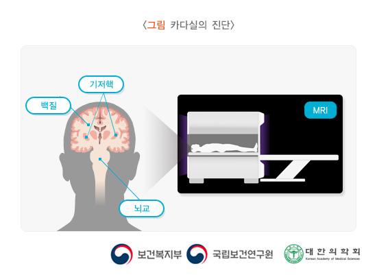 카다실의 진단: MRI에서 기저핵, 백질, 및 뇌교 부위 확인