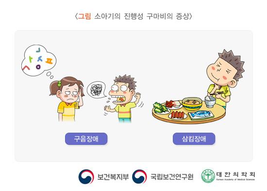 소아기의 진행성 구마비의 증상