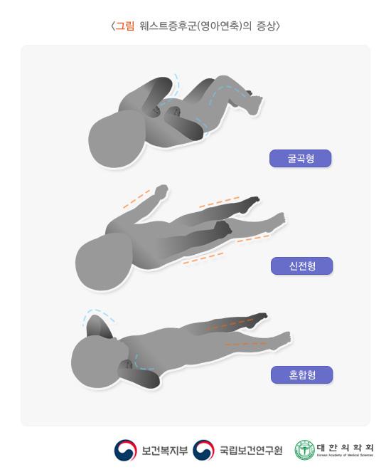 웨스트증후군(영아연축)의 증상