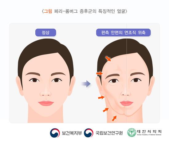 페리-롬버그 증후군의 특징적인 얼굴: 편측 안면의 연조직 위축